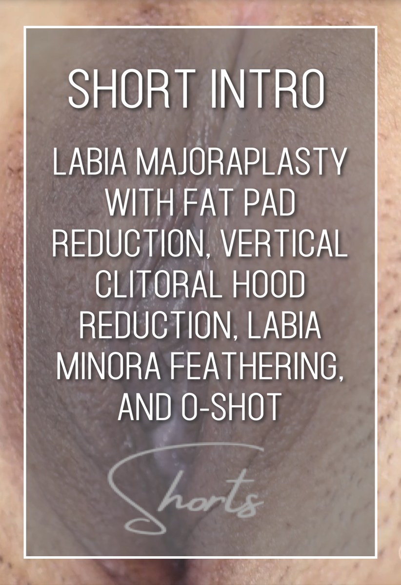 #21 Final Labia Majoraplasty with Fat Pad Reduction, Vertical Clitoral Hood Reduction, Labia Minora Feathering, and O-Shot Short Intro