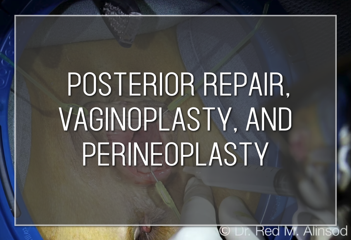 Labiaplasty Barbie Look