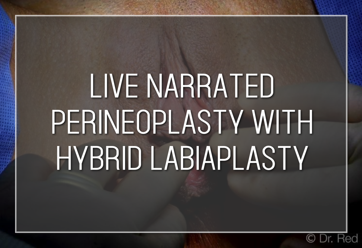 Labiaplasty Hybrid