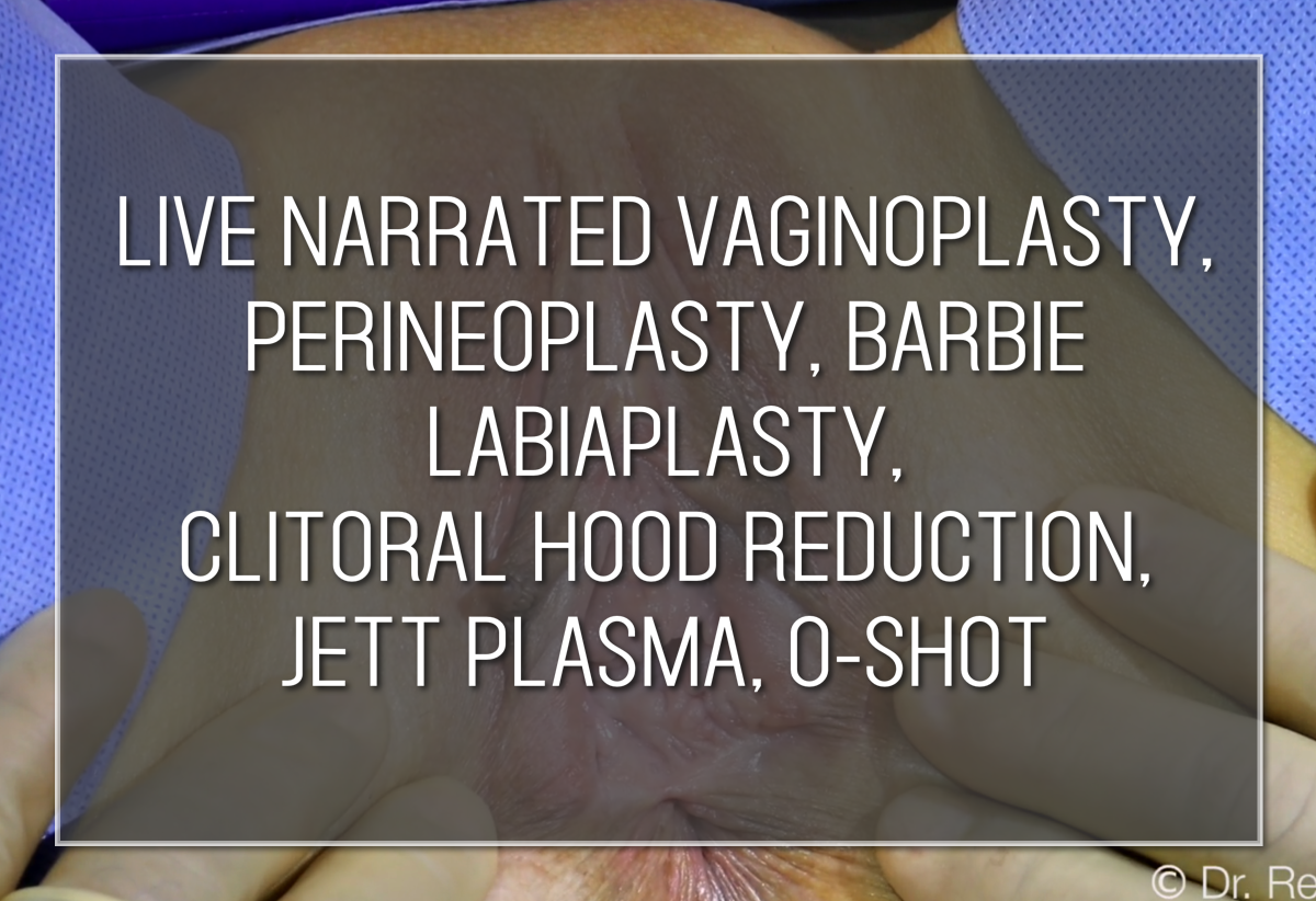 Labiaplasty Hybrid