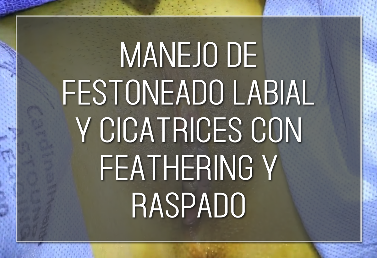 Labiaplasty Hybrid