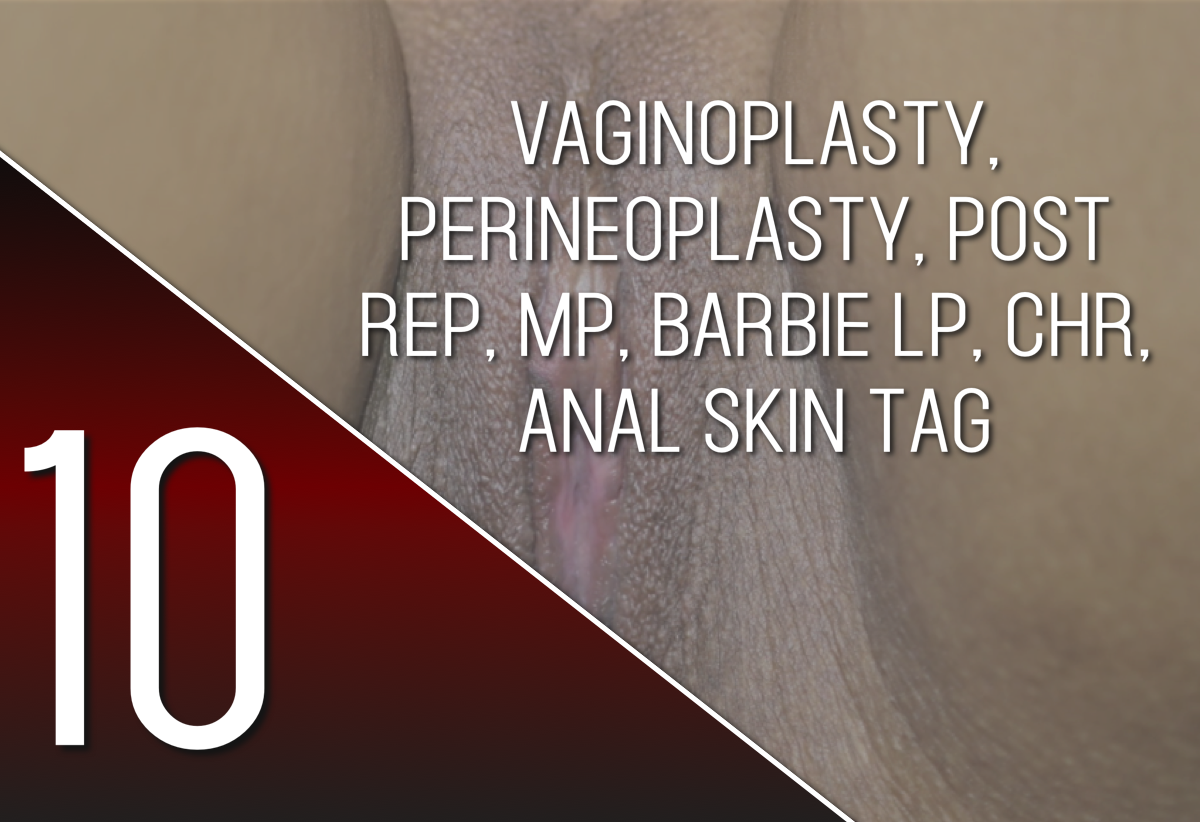 Labia Majoraplasty with Fat Pad Removal