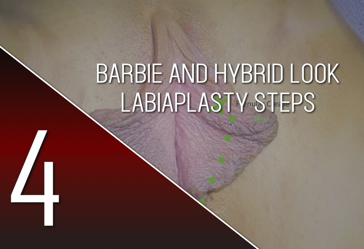 Labiaplasty 101 Primer Aesthetic Gyneocologic Energy Based Devices and Biologics