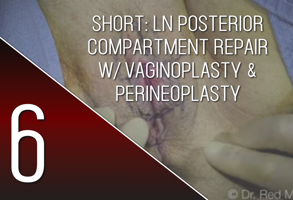A Lateral Clitoral Hood Reduction