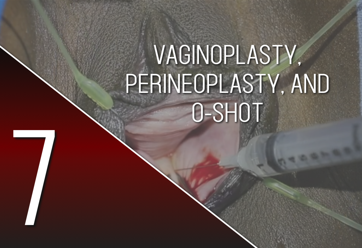Vaginoplasty, Perineoplasty, Barbie Labiaplasty, CHR, Anal Skin Tag, and Thermi-O