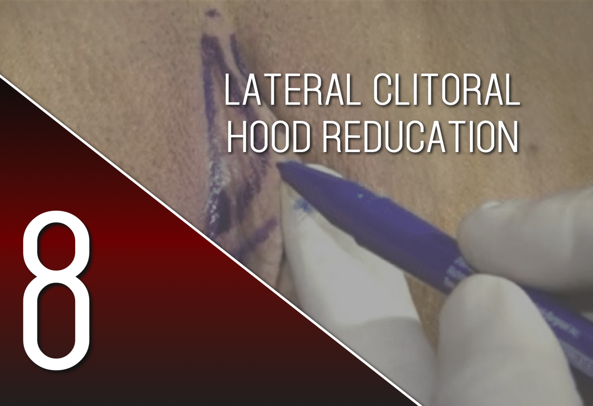 Rim Labiaplasty, Clitoral Hood Reduction, and Perineoplasty