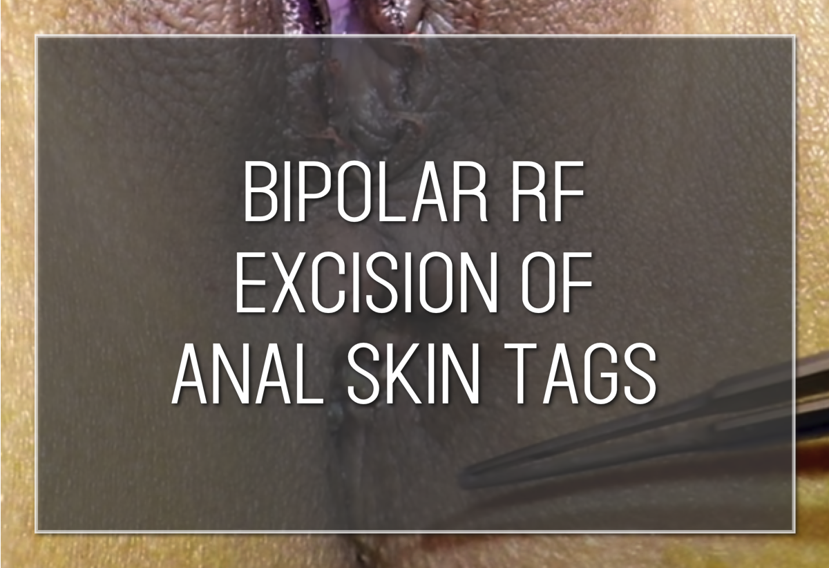 Labiaplasty Hybrid