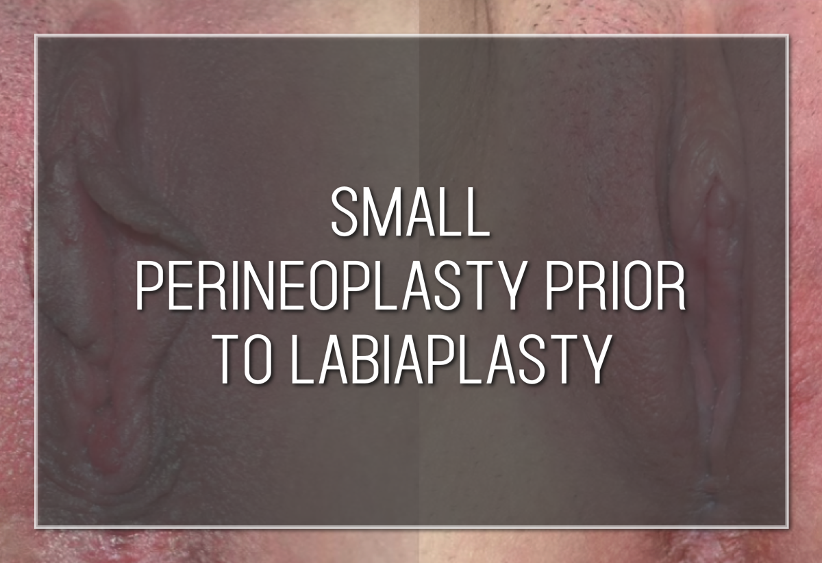 Labiaplasty Hybrid