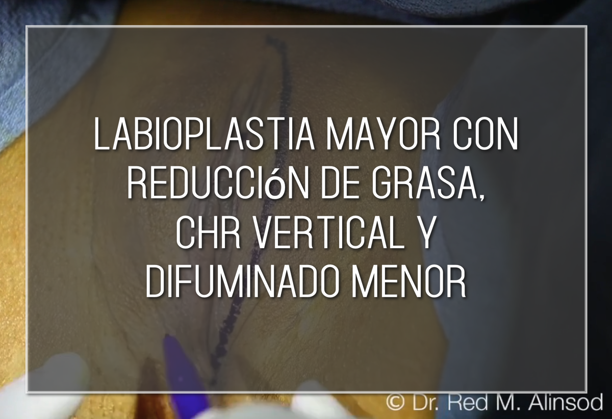 Anestesia y marcaje para labioplastia de labios mayores Labiaplasty Hybrid