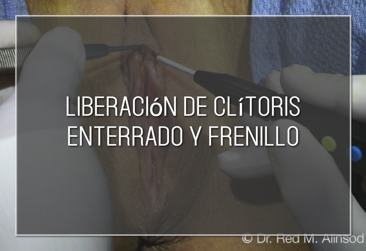 Liberación de clítoris enterrado y frenillo con PRP y fluido amniótico Labiaplasty Hybrid