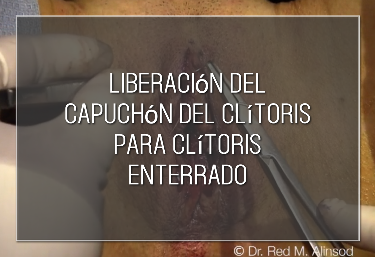 Liberación del capuchón del clítoris para clítoris enterrado Labiaplasty Hybrid
