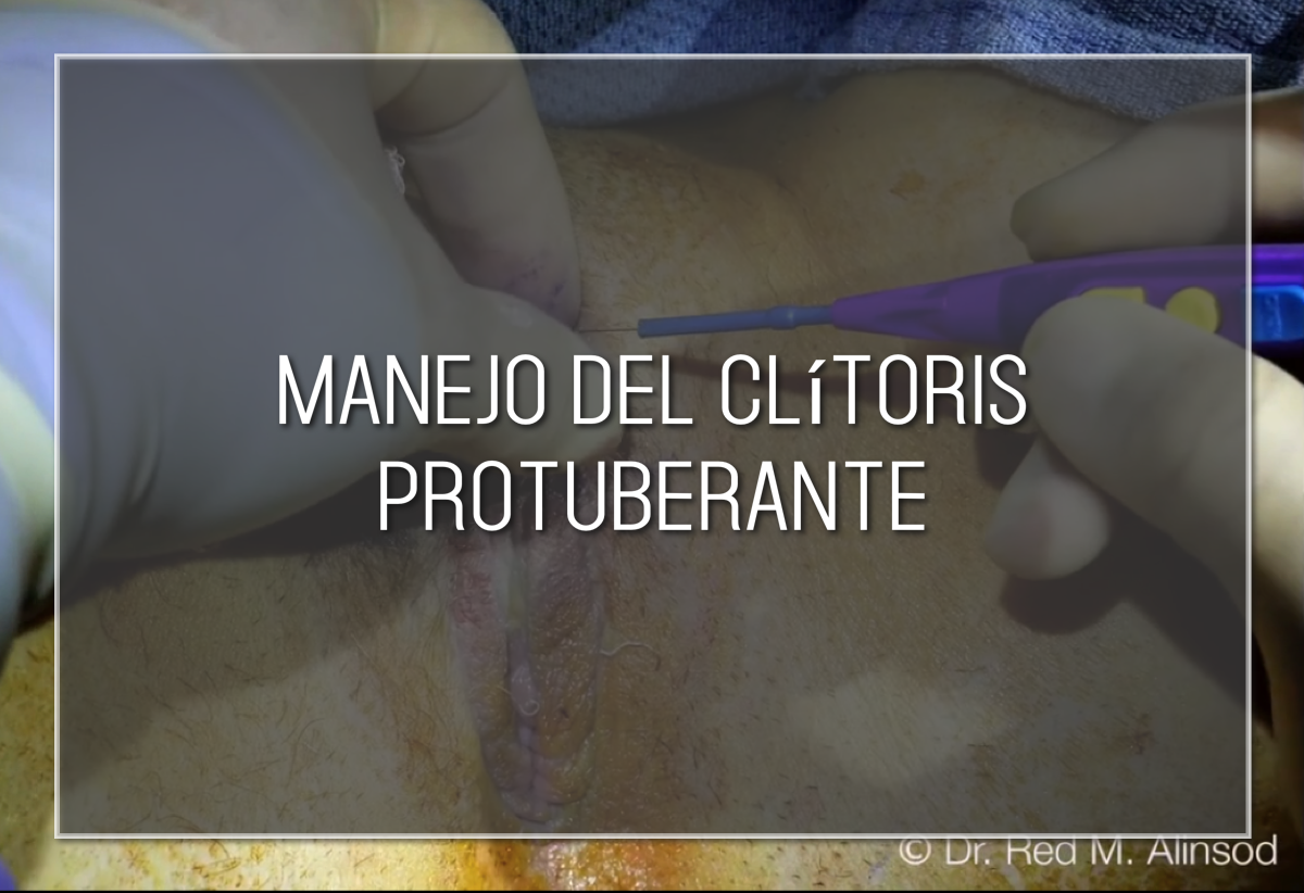 Manejo del clítoris protuberante Labiaplasty Hybrid