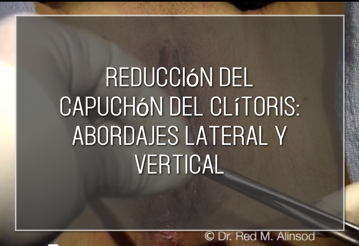 Reducción del capuchón del clítoris- abordajes lateral y vertical Labiaplasty Hybrid
