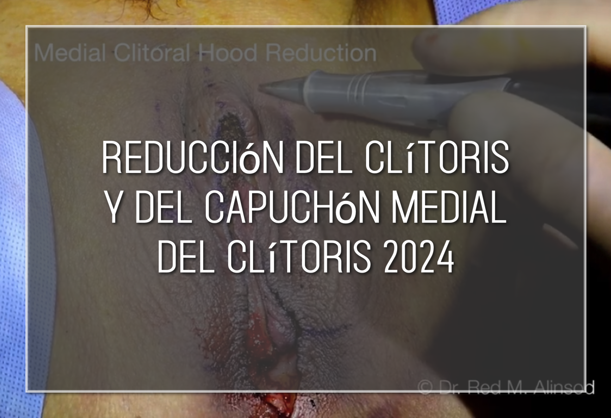 Reducción del clítoris y del capuchón medial del clítoris 2024 Labiaplasty Hybrid