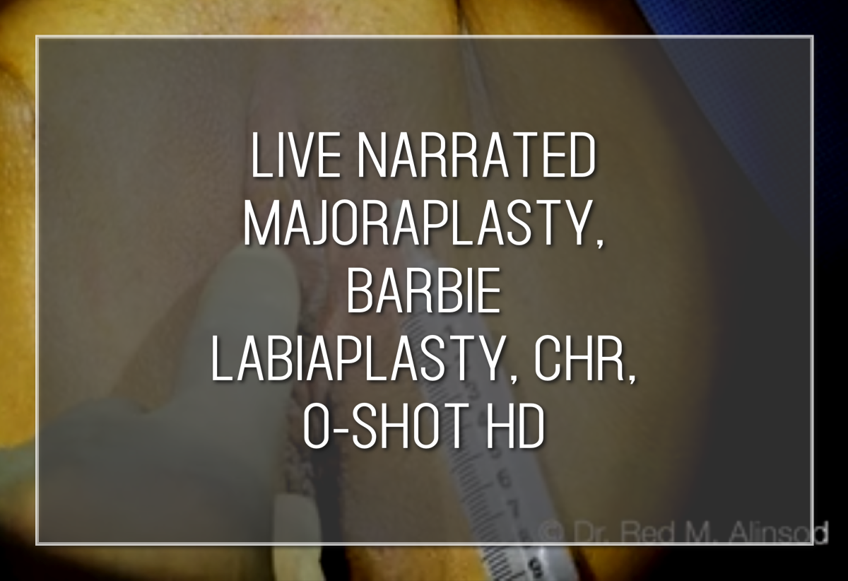 Live Narrated Majoraplasty, Barbie Labiaplasty, CHR, O-Shot HD Labiaplasty Hybrid