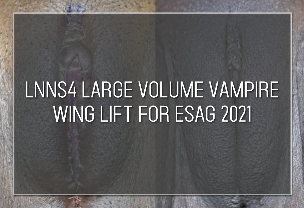 SHORTS: LNNS4 Large Volume Vampire Wing Lift for ESAG 2021 Labiaplasty Hybrid