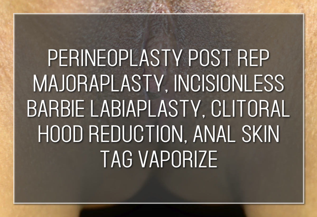 SHORTS: Perineo Post Rep MP, Incisionless Barbie LP, CHR, Anal Skin Tag Vaporiz Labiaplasty Hybrid