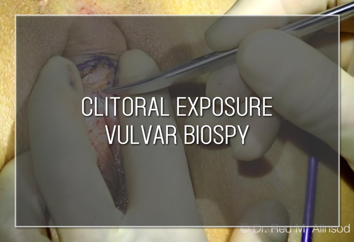 Clitoral Exposure Vulvar Biospy Labiaplasty Hybrid