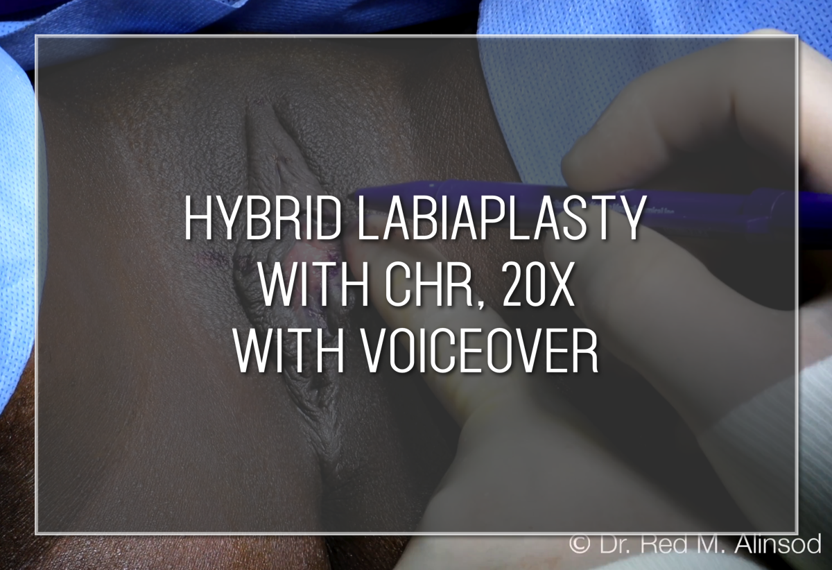 Hybrid Labiaplasty with CHR, 20X with Voiceover Labiaplasty Hybrid