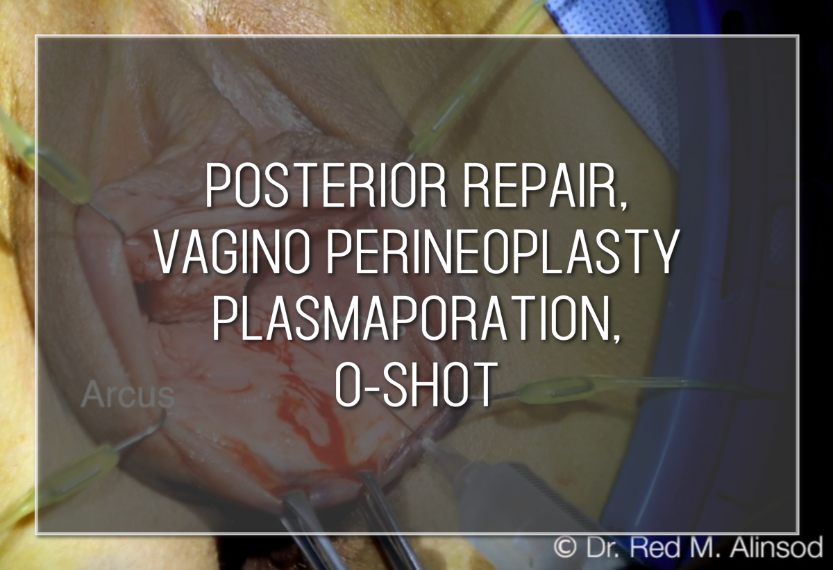 Posterior Repair, Vagino Perineoplasty Plasmaporation, o-shot Labiaplasty Hybrid